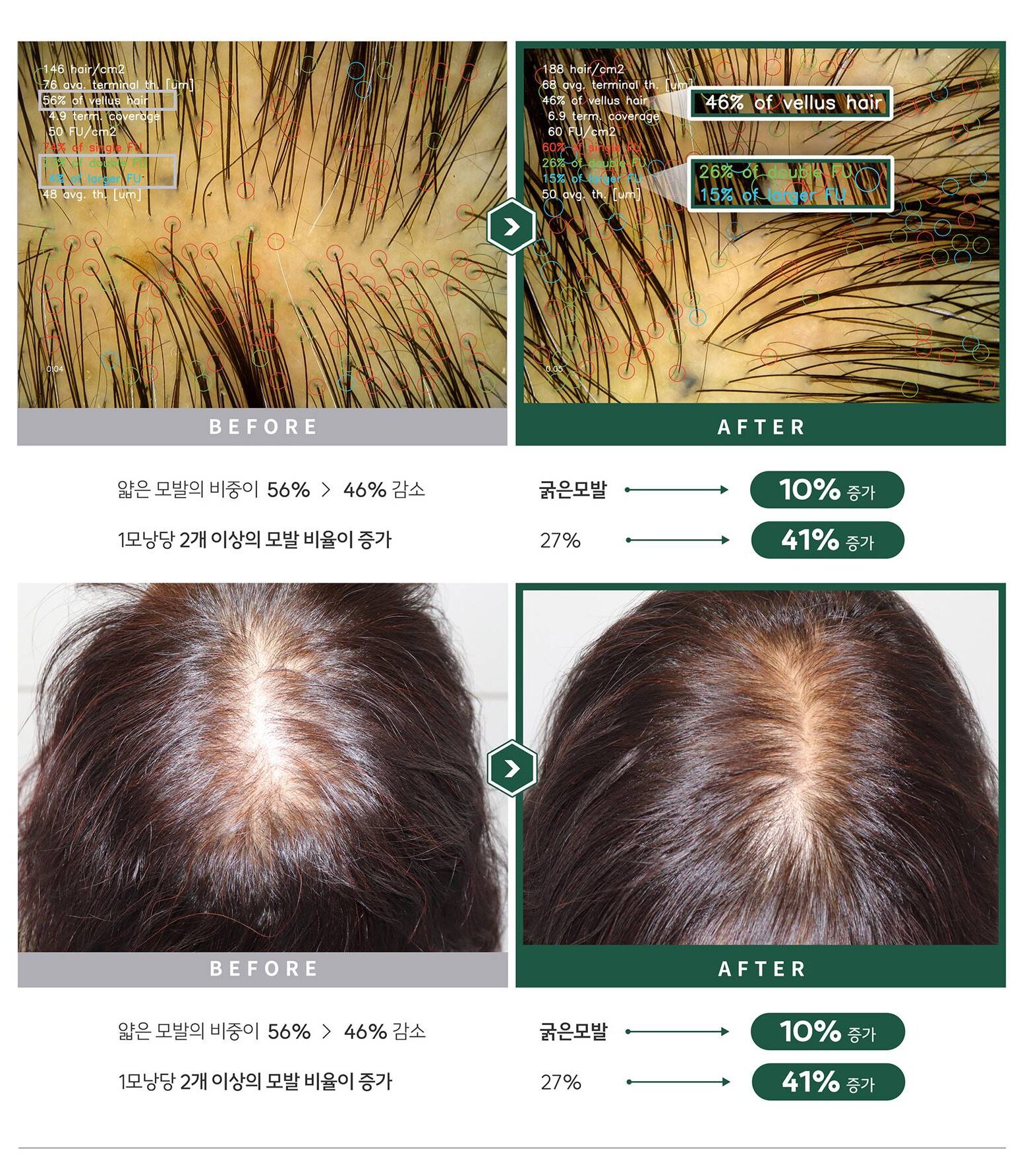 자가모근줄기세포 사진