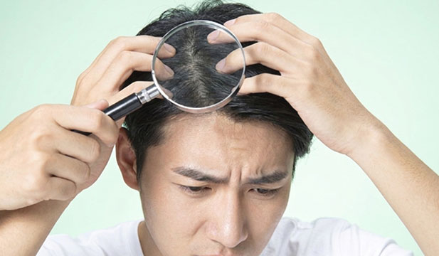 남자머리에 돋보기를 대고 있는 사진